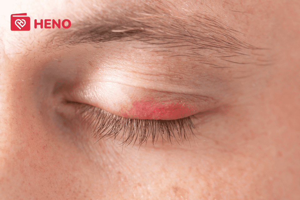 3 dấu hiệu, triệu chứng rõ ràng nhất cho thấy bạn đã bị bệnh chắp mắt